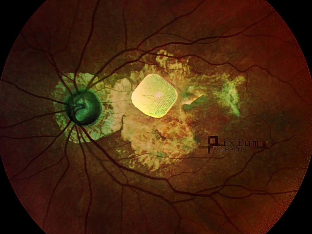 Bežični implantat od 2x2 mm kirurški se ugrađuje ispod mrežnice 📷 Pixium Vision