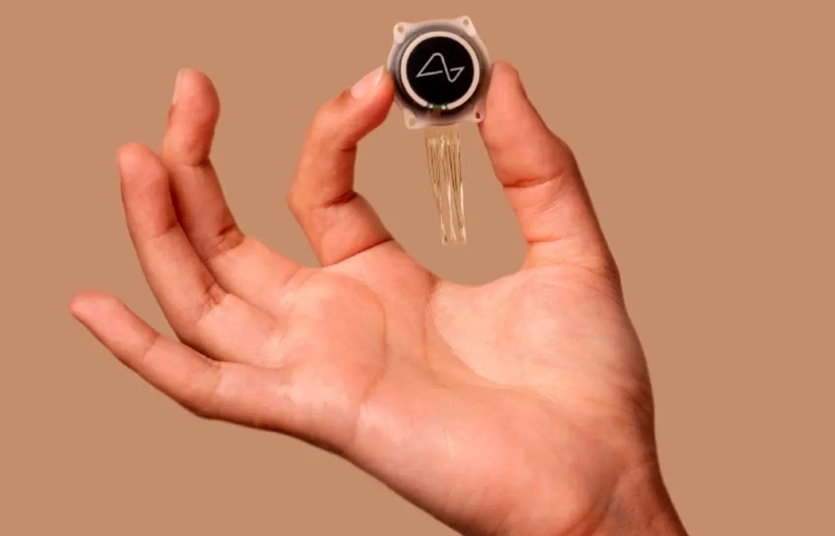 U mozgu drugog pacijenta trenutno je funkcionalno 400 elektroda implantata, otkrio je Elon Musk 📷 Neuralink